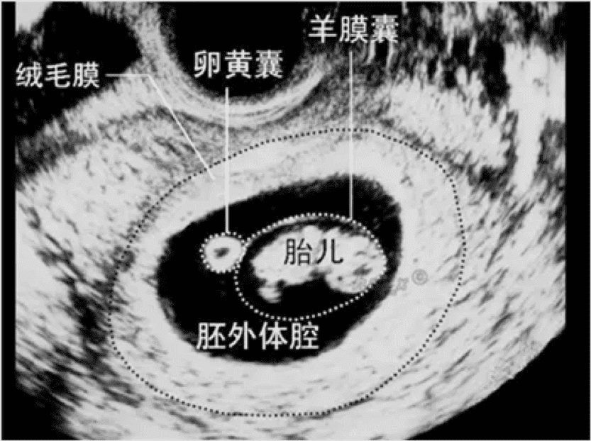 孕早期B超检查的目的